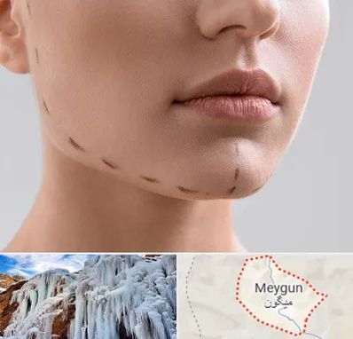 عمل زاویه فک در میگون