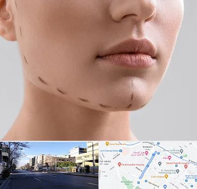 عمل زاویه فک در خیابان ملاصدرا شیراز