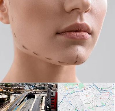 عمل زاویه فک در ستارخان شیراز