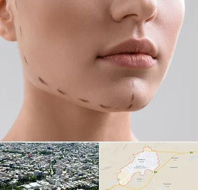 عمل زاویه فک در شاهرود