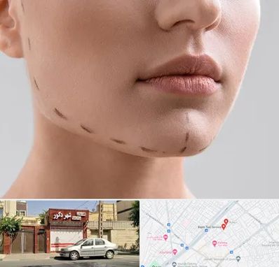 عمل زاویه فک در باجک قم