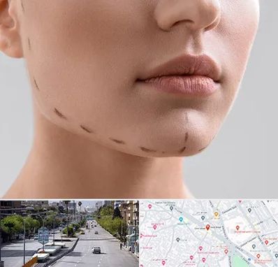 عمل زاویه فک در خیابان زند شیراز