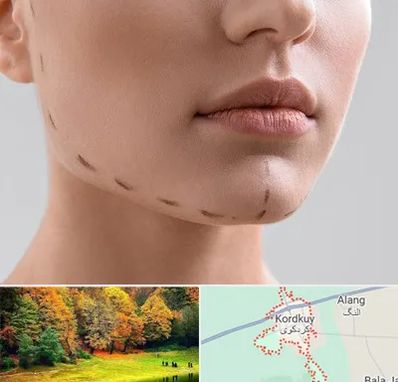 عمل زاویه فک در کردکوی