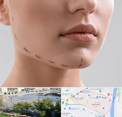 عمل زاویه فک در گلستان اهواز