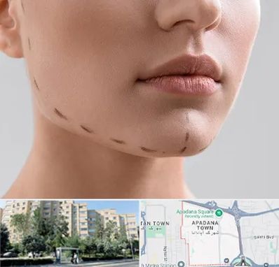 عمل زاویه فک در آپادانا