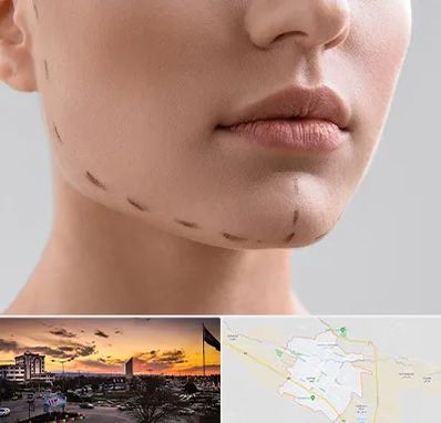 عمل زاویه فک در قوچان