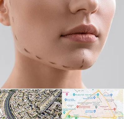 عمل زاویه فک در شهرک غرب مشهد