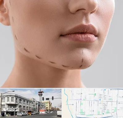 عمل زاویه فک در 17شهریور