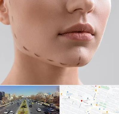 عمل زاویه فک در بلوار معلم مشهد