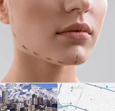 عمل زاویه فک در ازگل