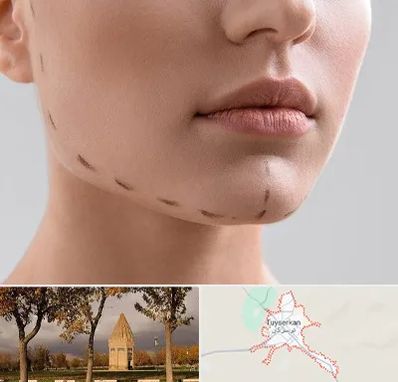 عمل زاویه فک در تویسرکان