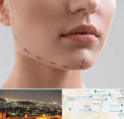 عمل زاویه فک در مارلیک کرج