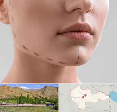 عمل زاویه فک در خاش