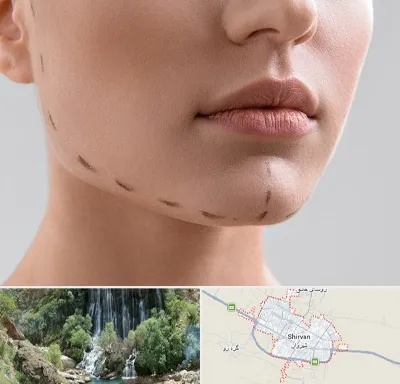 عمل زاویه فک در شیروان