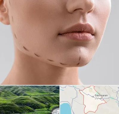 عمل زاویه فک در گچساران