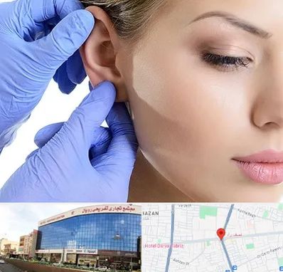 اتوپلاستی در نصف راه تبریز