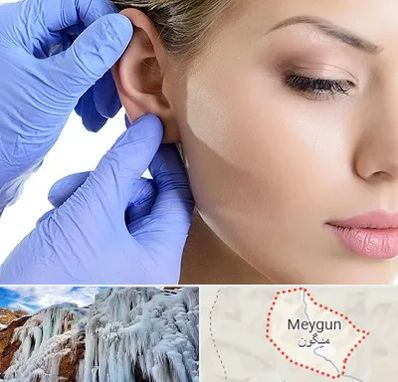 اتوپلاستی در میگون