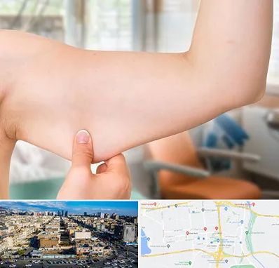 براکیوپلاستی در شهرک راه آهن