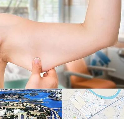 براکیوپلاستی در کوروش اهواز