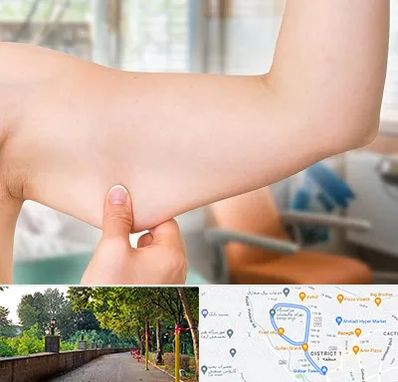 براکیوپلاستی در فلکه گاز رشت