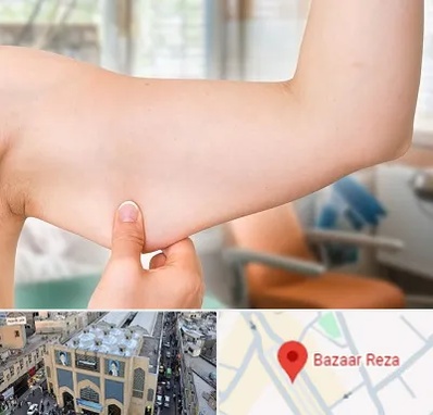 براکیوپلاستی در بازار رضا مشهد