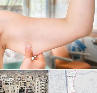 براکیوپلاستی در اسکندری