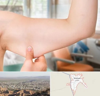 براکیوپلاستی در اسفراین