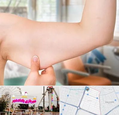 براکیوپلاستی در پادادشهر اهواز