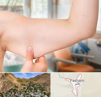 براکیوپلاستی در فشم