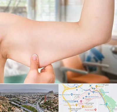 براکیوپلاستی در معالی آباد شیراز