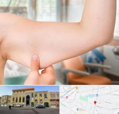 براکیوپلاستی در زنبیل آباد قم