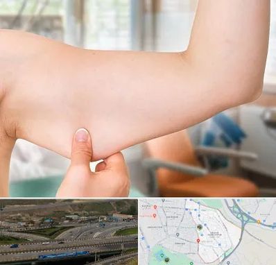 براکیوپلاستی در یاغچیان تبریز