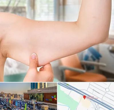 براکیوپلاستی در لاله پارک تبریز