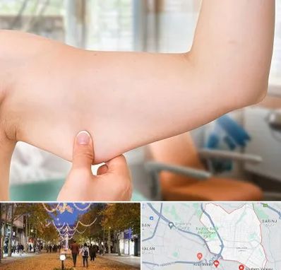 براکیوپلاستی در ولیعصر ارومیه