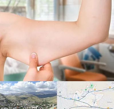 براکیوپلاستی در رودهن