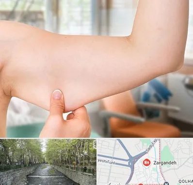 براکیوپلاستی در زرگنده