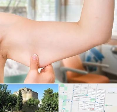 براکیوپلاستی در مرداویج اصفهان