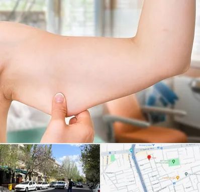 براکیوپلاستی در کوی فیروز تبریز