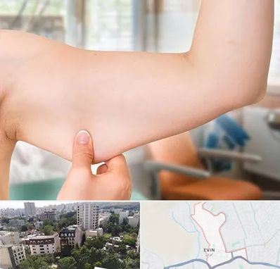 براکیوپلاستی در اوین