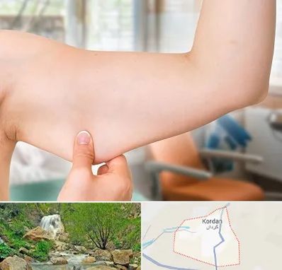 براکیوپلاستی در کردان