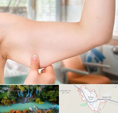 براکیوپلاستی در دورود