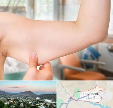 براکیوپلاستی در لواسان