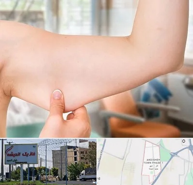 براکیوپلاستی در فاز یک اندیشه