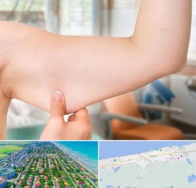 براکیوپلاستی در فریدونکنار