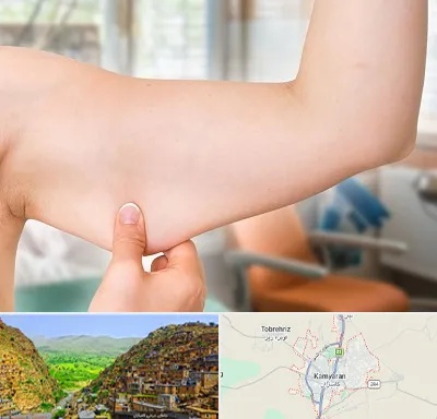 براکیوپلاستی در کامیاران