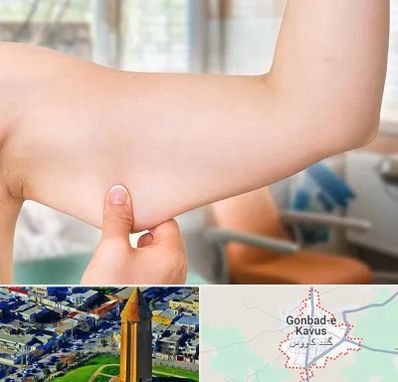 براکیوپلاستی در گنبد کاووس