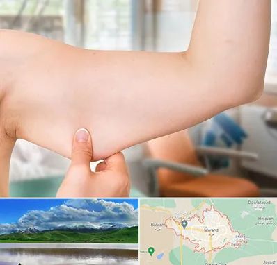 براکیوپلاستی در مرند