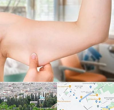 براکیوپلاستی در محلاتی شیراز