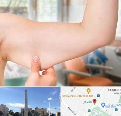 براکیوپلاستی در فلکه گاز شیراز