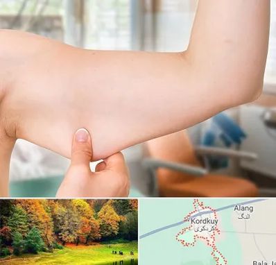 براکیوپلاستی در کردکوی